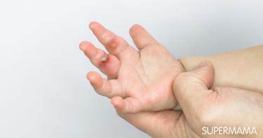 الاحتياطات المنزلية لتجنب جميع أنواع الحروق عند الأطفال. سوبر ماما