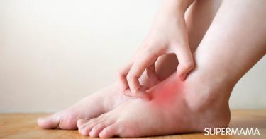 9 أمراض جلدية تسبب حكة القدمين سوبر ماما