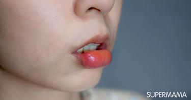 ما هو علاج الشفاه المنتفخة؟ سوبر ماما