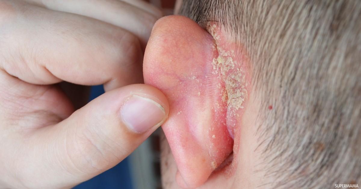 ما أسباب أكزيما خلف الأذن عند الأطفال؟ سوبر ماما